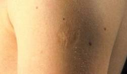 Smallpox Vaccination Scar